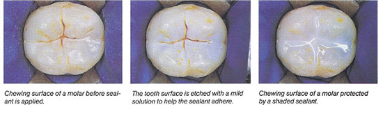 sealant