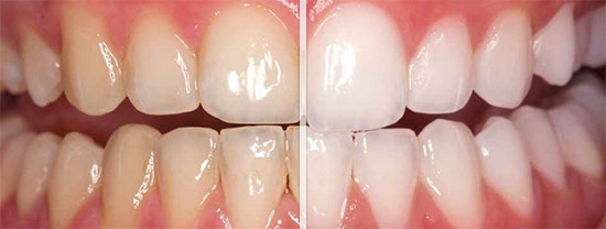 teeth-whitening